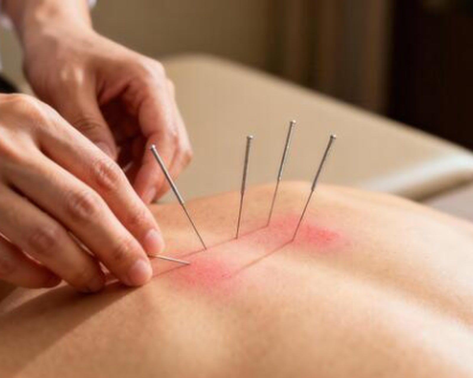 Four needles in the back muscles during a dry needling treatment.